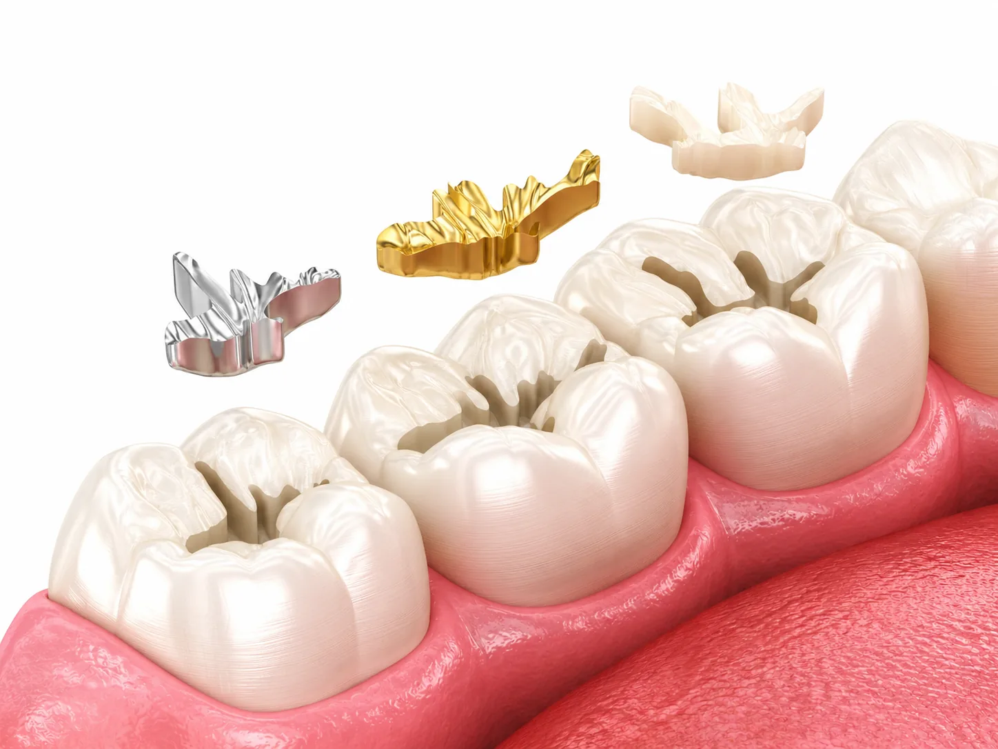 Tooth colored dental fillings at Vasantha Dental Clinic Vizag